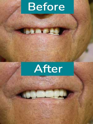 Smile Gallery Before After 1