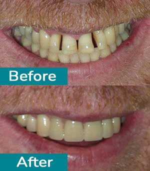 Smile Gallery Before After 4