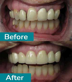 Smile Gallery Before After 5