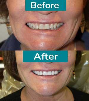 Smile Gallery Before After 6