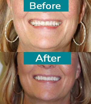 Smile Gallery Before After 7