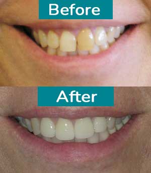 Smile Gallery Before After 8