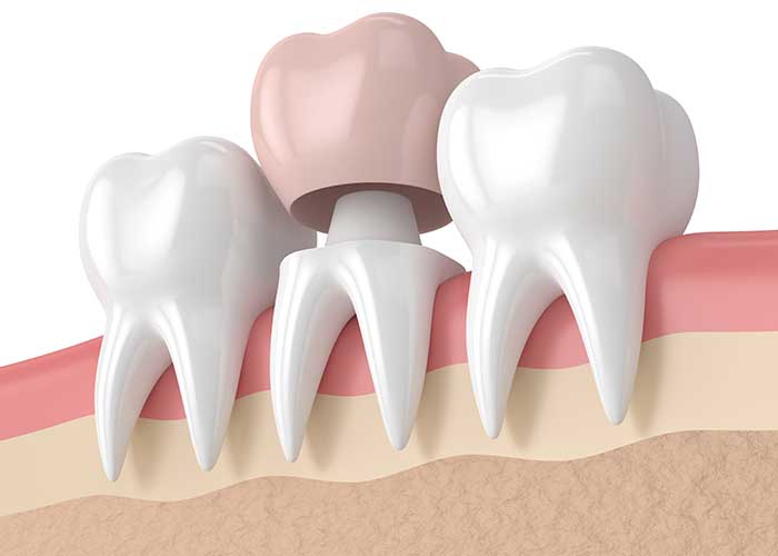 Porcelain Dental Crowns in Westminster CO Area