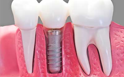 Dental Implant 2D