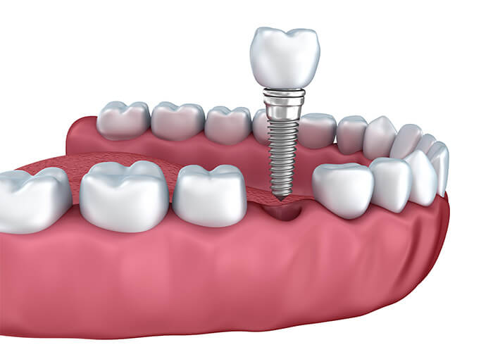 Dental Implant Services in Westminster CO Area