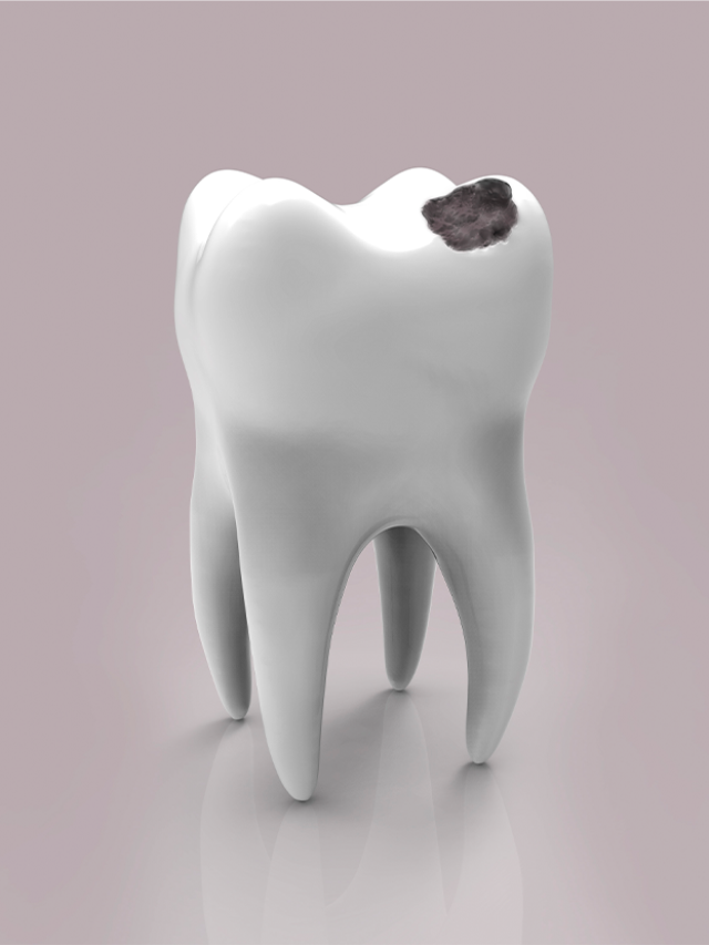 Cavities start small but can grow fast, resulting in sensitivity