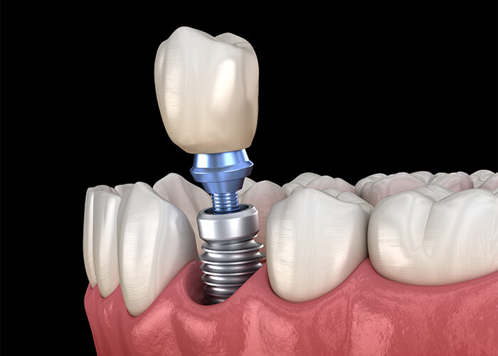 Are Dental Implants Painful in Westminster CO Area
