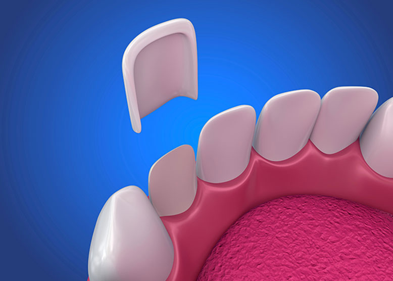 Porcelain Veneers in Westminster CO Area